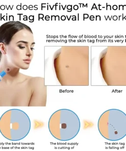 Fivfivgo™ At-home Skin Tag Removal Pen