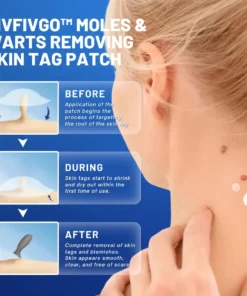 Fivfivgo™ Moles & Warts Removing Skin Tag Patch