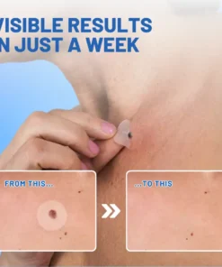 Fivfivgo™ Moles & Warts Removing Skin Tag Patch