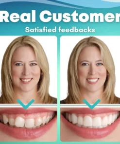 Fivfivgo™ SnapOn Silicone Veneers