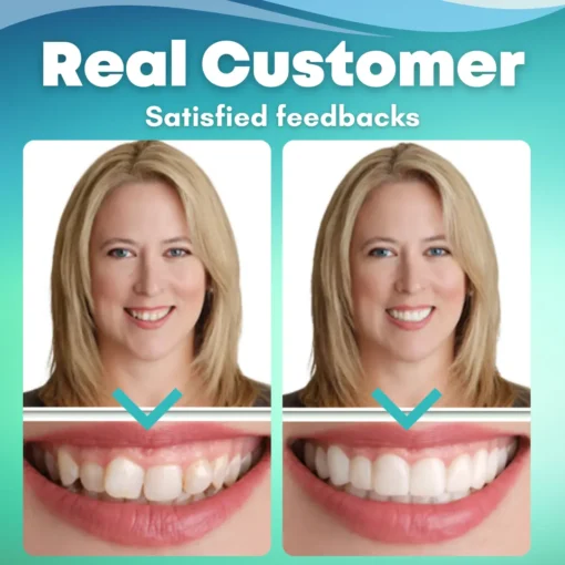 Fivfivgo™ SnapOn Silicone Veneers