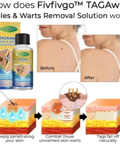 Fivfivgo™ TAGAway Moles & Warts Removal Solution