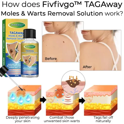 Fivfivgo™ TAGAway Moles & Warts Removal Solution