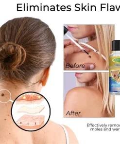 Fivfivgo™ TAGAway Moles & Warts Removal Solution