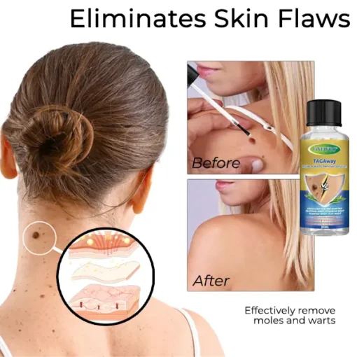 Fivfivgo™ TAGAway Moles & Warts Removal Solution