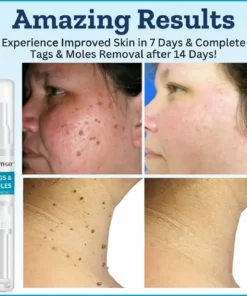 Fivfivgo™ Tags & Moles Corrector