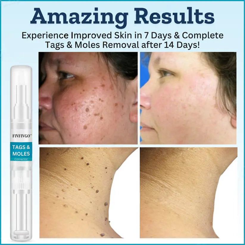 Fivfivgo™ Tags & Moles Corrector