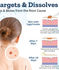 Fivfivgo™ Tags & Moles Corrector