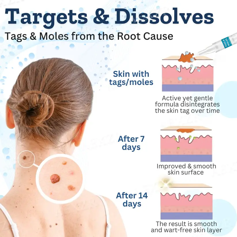 Fivfivgo™ Tags & Moles Corrector