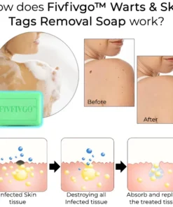 Fivfivgo™ Warts & Skin Tags Removal Soap