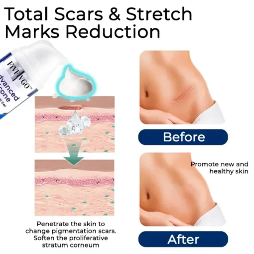 Fivfivgo™ Advanced Silicone Scar Removal Gel