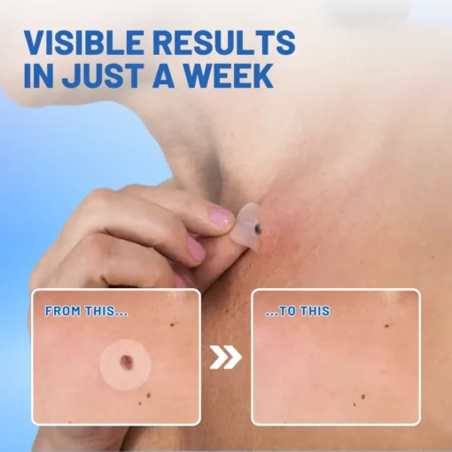 Fivfivgo™ Moles & Warts Removing Skin Tag Patch