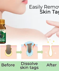 Fivfivgo® Bacteriostatic Black Cumin Skin Tag Remover