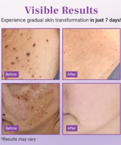 Fivfivgo® DermaClear Mole and Dark Spot Removal Bio-Gel