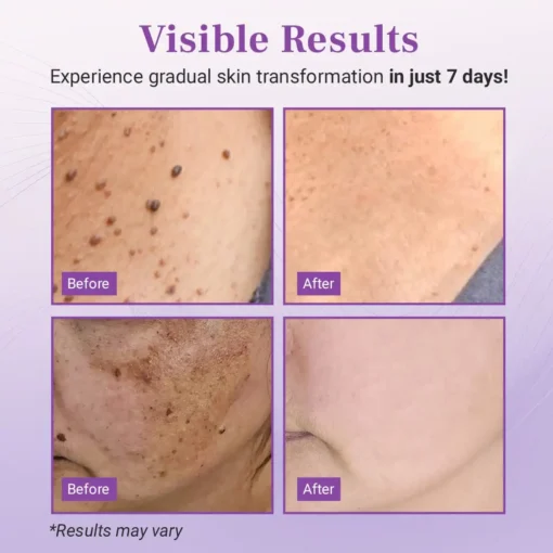 Fivfivgo® DermaClear Mole and Dark Spot Removal Bio-Gel