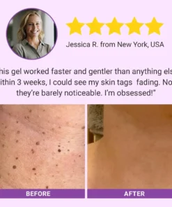 Fivfivgo® DermaClear Mole and Dark Spot Removal Bio-Gel