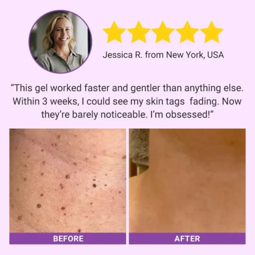 Fivfivgo® DermaClear Mole and Dark Spot Removal Bio-Gel