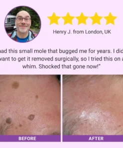 Fivfivgo® DermaClear Mole and Dark Spot Removal Bio-Gel