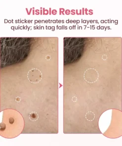 Fivfivgo® Painless Micro Wart Removal Patch