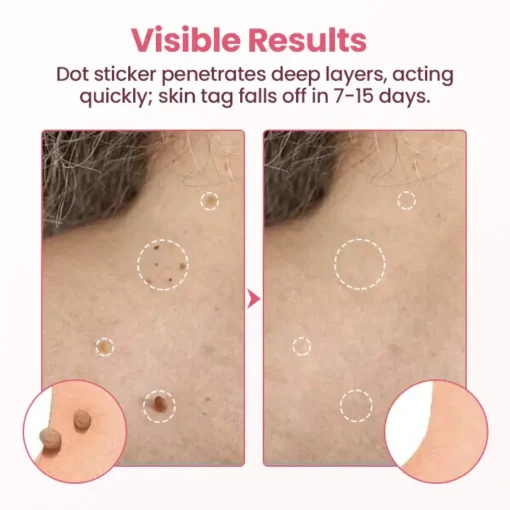 Fivfivgo® Painless Micro Wart Removal Patch