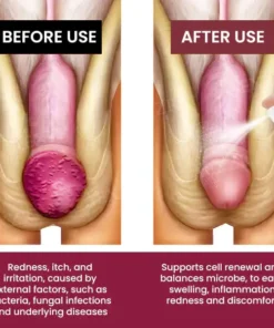 Fivfivgo® Balanitis Treatment Spray