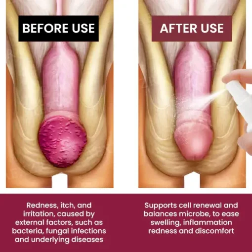 Fivfivgo® Balanitis Treatment Spray