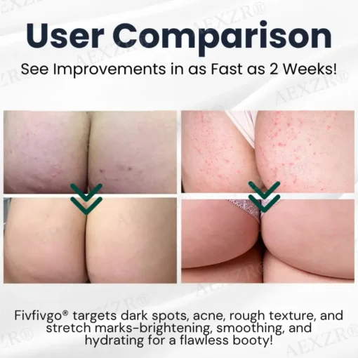 Fivfivgo® Butt Skin Treatment Cream