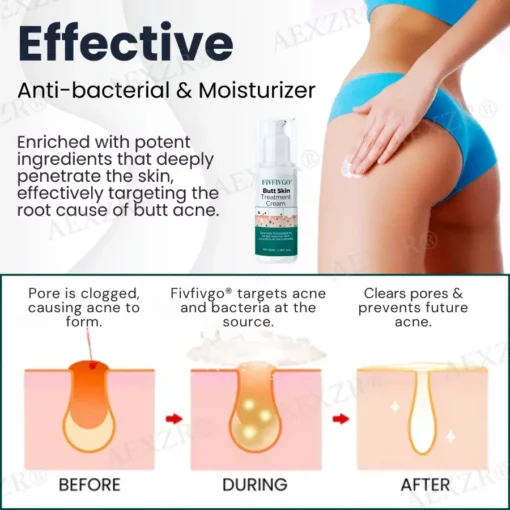Fivfivgo® Butt Skin Treatment Cream