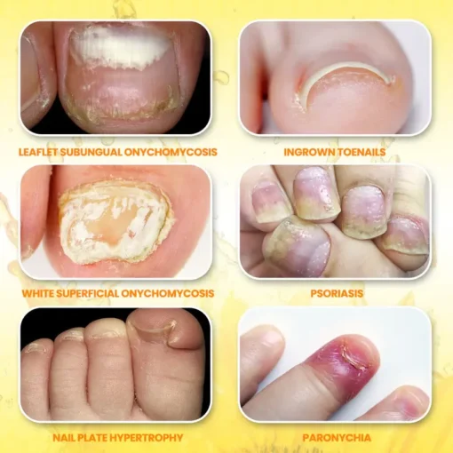 Fivfivgo® ClariNail Bee Venom Fungal Solution Drops