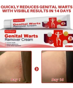 Fivfivgo® FloraGuard HPV Genital Warts Remover