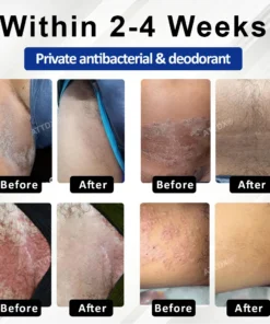 Fivfivgo® LicorRelief Man Genital Antifungal Cream
