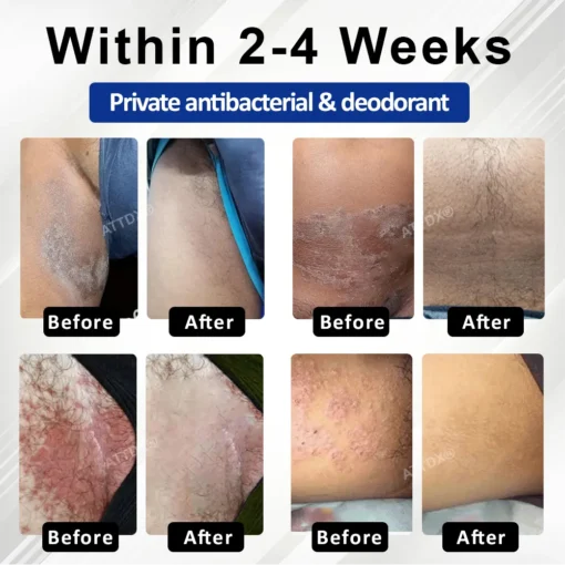 Fivfivgo® LicorRelief Man Genital Antifungal Cream