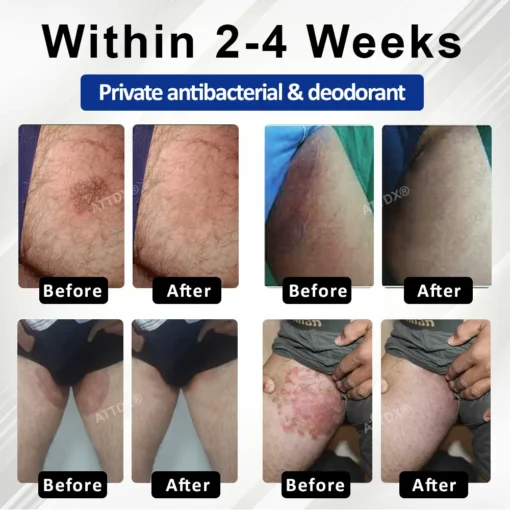 Fivfivgo® LicorRelief Man Genital Antifungal Cream