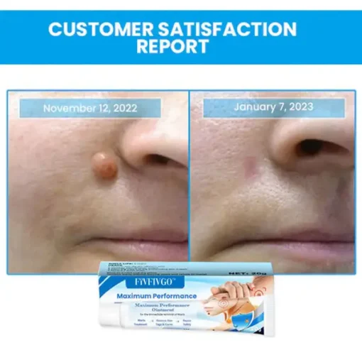 Fivfivgo™ Maximum Performance Ointment for the Immediate removal of Warts