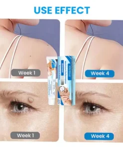Fivfivgo™ Maximum Performance Ointment for the Immediate removal of Warts