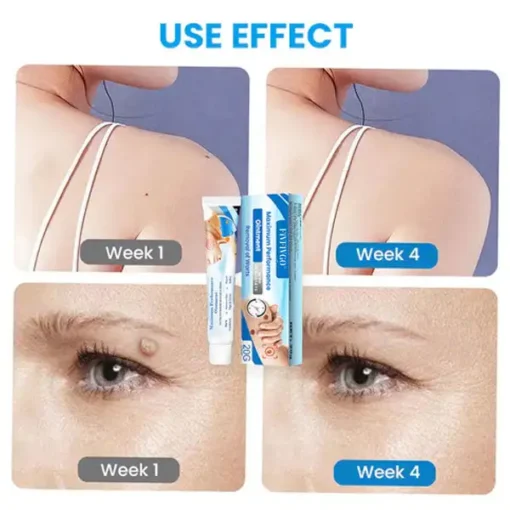 Fivfivgo™ Maximum Performance Ointment for the Immediate removal of Warts