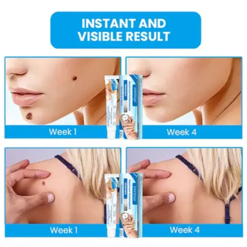 Fivfivgo™ Maximum Performance Ointment for the Immediate removal of Warts