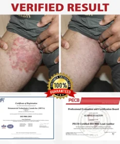 Fivfivgo® Men's HPV Warts Care Spray