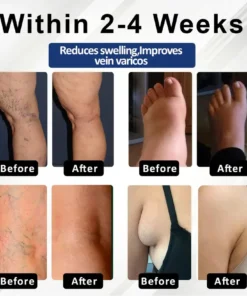 Fivfivgo® VenoHerb Black Cumin Edema Relief Balm