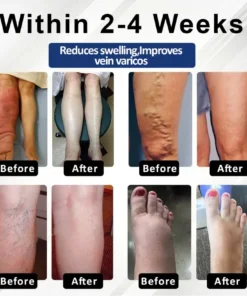 Fivfivgo® VenoHerb Black Cumin Edema Relief Balm