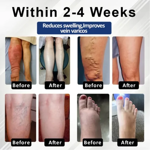 Fivfivgo® VenoHerb Black Cumin Edema Relief Balm