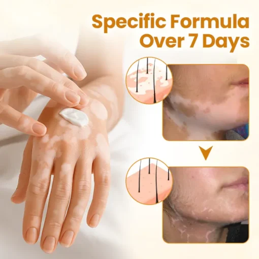 Fivfivgo® VitiClear Pro Bee Venom Cream