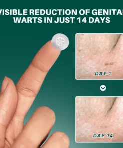 Fivfivgo® Magnesium MicroPin HPV Genital Wart Removal Patch