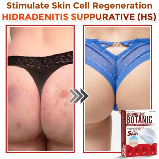 Fivfivgo® MicroNeedle Botanic Skin Tag Removal Patch