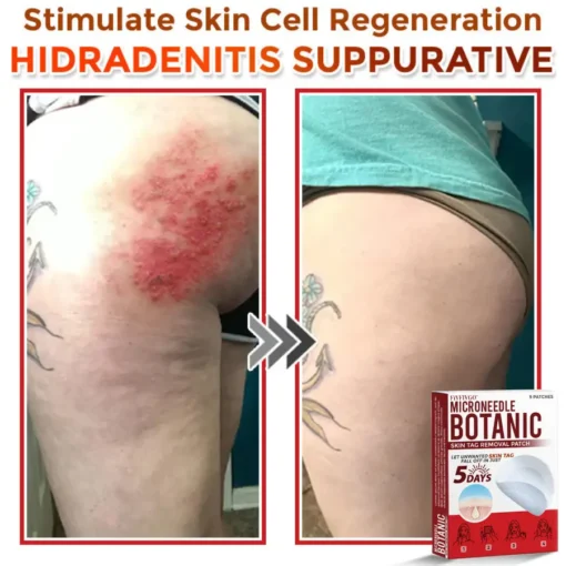 Fivfivgo® MicroNeedle Botanic Skin Tag Removal Patch