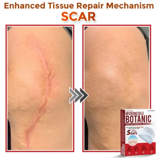 Fivfivgo® MicroNeedle Botanic Skin Tag Removal Patch