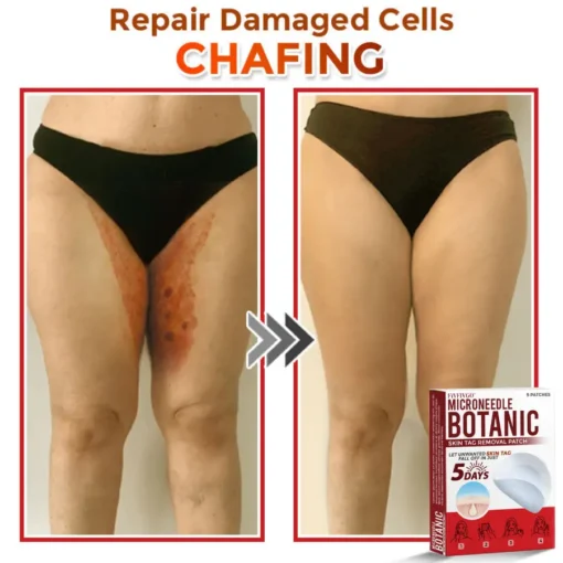 Fivfivgo® MicroNeedle Botanic Skin Tag Removal Patch
