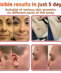 Fivfivgo® MicroNeedle Botanic Skin Tag Removal Patch