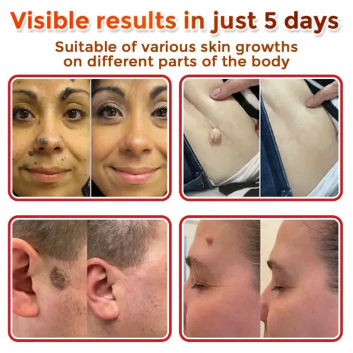 Fivfivgo® MicroNeedle Botanic Skin Tag Removal Patch