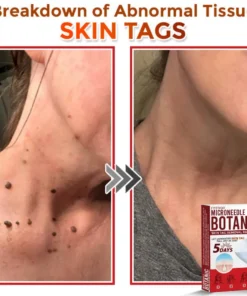 Fivfivgo® MicroNeedle Botanic Skin Tag Removal Patch